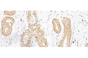 Immunohistochemistry of paraffin-embedded Human breast cancer tissue using BEX2 Polyclonal Antibody at dilution of 1:45(x200) (BEX2 抗体)
