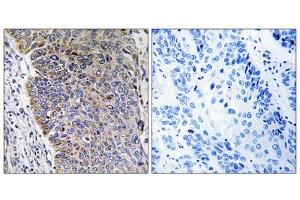 Immunohistochemistry analysis of paraffin-embedded human lung carcinoma tissue using MGST3 antibody. (MGST3 抗体  (N-Term))