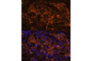 Immunofluorescence analysis of human kidney cancer using SLC7 antibody (ABIN6130697, ABIN6148048, ABIN6148049 and ABIN6216625) at dilution of 1:100. (SLC7A9 抗体  (AA 1-100))