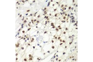 Immunohistochemistry of paraffin-embedded human kidney cancer using MSH6 antibody (ABIN5970371) at dilution of 1/100 (40x lens).