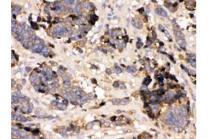 Anti- Prealbumin Picoband antibody,IHC(P) IHC(P): Human Lung Cancer Tissue (TTR 抗体  (AA 21-147))