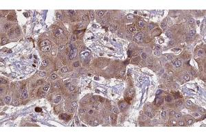 ABIN6269005 at 1/100 staining Human liver cancer tissue by IHC-P. (Metabotropic Glutamate Receptor 4 抗体  (C-Term))