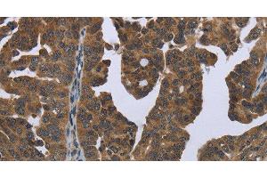 Immunohistochemistry of paraffin-embedded Human ovarian cancer tissue using GYS2 Polyclonal Antibody at dilution 1:50 (Glycogen Synthase 2 抗体)