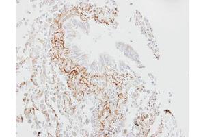 IHC-P Image Immunohistochemical analysis of paraffin-embedded human lung fibrose tissue, using SGLT1, antibody at 1:100 dilution. (SLC5A1 抗体  (Center))