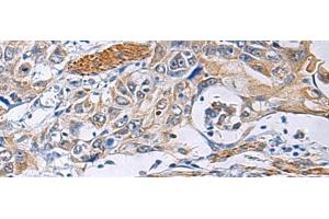 Immunohistochemistry of paraffin-embedded Human esophagus cancer tissue using FBXO45 Polyclonal Antibody at dilution of 1:40(x200) (FBXO45 抗体)