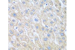 Immunohistochemistry of paraffin-embedded Human liver cancer using PTGS1 Polyclonal Antibody at dilution of 1:100 (40x lens). (PTGS1 抗体)