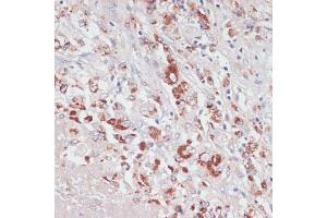 Immunohistochemistry of paraffin-embedded human liver cancer using Lysozyme (Lysozyme (LYZ)) antibody (ABIN6133802, ABIN6143409, ABIN6143412 and ABIN6217538) at dilution of 1:100 (40x lens). (LYZ 抗体  (AA 1-100))