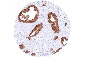 Ductal adenocarcinoma of the pancreas with strong TFF1 staining of all tumor cells (TFF1 抗体  (AA 1-88))