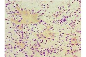 Immunohistochemistry of paraffin-embedded human breast cancer using ABIN7166413 at dilution of 1:100 (Transglutaminase 2 抗体  (AA 438-687))