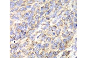 Immunohistochemistry of paraffin-embedded Human esophageal cancer using ACY1 Polyclonal Antibody at dilution of 1:100 (40x lens). (Aminoacylase 1 抗体)