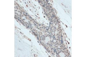 Immunohistochemistry of paraffin-embedded human breast using antibody (ABIN6130837, ABIN6140958, ABIN6140959 and ABIN6214740) at dilution of 1:100 (40x lens). (GAPDHS 抗体  (AA 179-408))