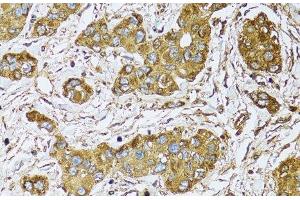 Immunohistochemistry of paraffin-embedded Human liver cancer using UGDH Polyclonal Antibody at dilution of 1:100 (40x lens). (UGDH 抗体)