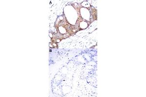 Immunohistochemical staining of human breast cancer tissue by GSK3A (phospho S21) polyclonal antibody  without blocking peptide (A) or preincubated with blocking peptide (B) under 1:50-1:100 dilution. (GSK3 alpha 抗体  (pSer21))