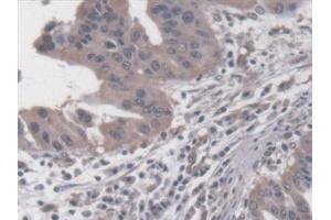 Detection of RDX in Human Liver cancer Tissue using Polyclonal Antibody to Radixin (RDX) (Radixin 抗体  (AA 5-295))