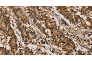 Immunohistochemistry of paraffin-embedded Human colon cancer using PSMC2 Polyclonal Antibody at dilution of 1:30 (PSMC2 抗体)