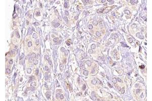 ABIN6269189 at 1/100 staining Human breast cancer tissue by IHC-P. (Filamin A 抗体  (Internal Region))