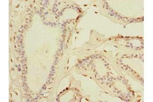 Immunohistochemistry of paraffin-embedded human breast cancer using ABIN7171935 at dilution of 1:100 (TTC33 抗体  (AA 1-262))
