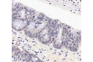 Immunohistochemistry analysis of paraffin-embedded human colon cancer using PARN (ABIN7075117) at dilution of 1: 1800 (PARN 抗体)