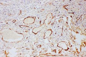 Anti- Adiponectin antibody, IHC(P) IHC(P): Human Lung Cancer Tissue (ADIPOQ 抗体  (AA 19-244))