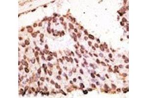 IHC analysis of FFPE human breast carcinoma tissue stained with the MMP7 antibody (MMP7 抗体  (AA 117-146))
