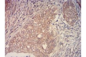 Immunohistochemical analysis of paraffin-embedded cervical cancer tissues using KMT2C mouse mAb with DAB staining. (MLL3 抗体  (AA 1-205))