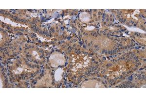 Immunohistochemistry of paraffin-embedded Human thyroid cancer using FADS1 Polyclonal Antibody at dilution of 1:60 (FADS1 抗体)