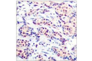 Immunohistochemical analysis of paraffin-embedded human breast carcinoma tissue using JunD (Ab-255) antibody (E021028). (JunD 抗体)