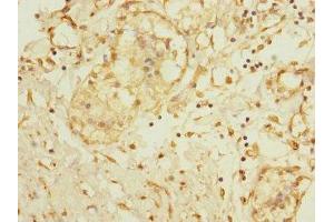 Immunohistochemistry of paraffin-embedded human breast cancer using ABIN7150051 at dilution of 1:100 (ADAM28 抗体  (AA 199-440))