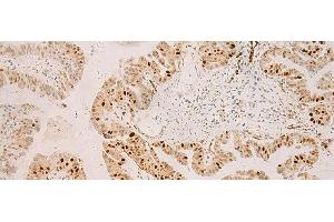 Immunohistochemistry of paraffin-embedded Human liver cancer tissue using RFX6 Polyclonal Antibody at dilution of 1:50(x200) (RFX6 抗体)