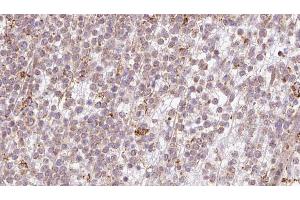 ABIN6273200 at 1/100 staining Human lymph cancer tissue by IHC-P. (BBS10 抗体  (Internal Region))