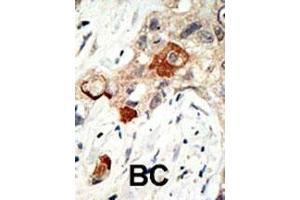 Formalin-fixed and paraffin-embedded human cancer tissue reacted with the primary antibody, which was peroxidase-conjugated to the secondary antibody, followed by AEC staining. (UBE2I 抗体  (N-Term))