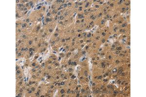 Immunohistochemistry of Human thyroid cancer using DUSP26 Polyclonal Antibody at dilution of 1:60 (DUSP26 抗体)