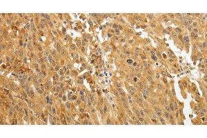 Immunohistochemistry of paraffin-embedded Human ovarian cancer using AKR1A1 Polyclonal Antibody at dilution of 1:30 (AKR1A1 抗体)