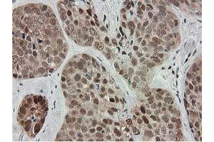 Immunohistochemical staining of paraffin-embedded Adenocarcinoma of Human breast tissue using anti-SMS mouse monoclonal antibody. (SMS 抗体)
