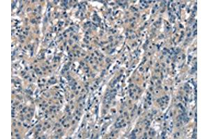 The image on the left is immunohistochemistry of paraffin-embedded Human gastric cancer tissue using ABIN7189631(ACPT Antibody) at dilution 1/30, on the right is treated with synthetic peptide. (Testicular Acid Phosphatase (ACP4) 抗体)