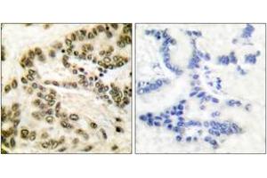 Immunohistochemistry analysis of paraffin-embedded human lung carcinoma tissue, using CREB (Ab-142) Antibody. (CREB1 抗体  (AA 111-160))