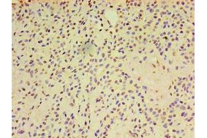 Immunohistochemistry of paraffin-embedded human breast cancer using ABIN7143455 at dilution of 1:100 (ARF6 抗体  (AA 1-175))