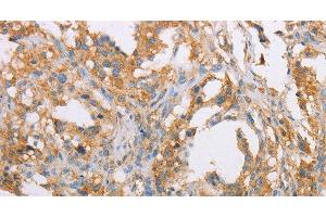 Immunohistochemistry of paraffin-embedded Human thyroid cancer tissue using ACTR2 Polyclonal Antibody at dilution 1:40 (ACTR2 抗体)