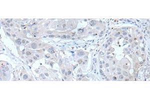 Immunohistochemistry of paraffin-embedded Human esophagus cancer tissue using ANGPTL6 Polyclonal Antibody at dilution of 1:55(x200) (ANGPTL6 抗体)