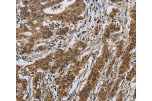 Immunohistochemistry of Human gastric cancer using IL5RA Polyclonal Antibody at dilution of 1:40 (IL5RA 抗体)