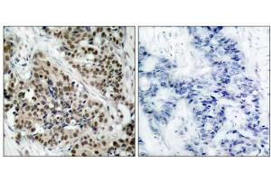Immunohistochemical analysis of paraffin- embedded human breast carcinoma tissue using FKHR (phospho-Ser256) antibody (E011115). (FOXO1 抗体  (pSer256))