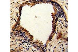 IHC analysis of FFPE human prostate carcinoma with NDRG1 antibody (NDRG1 抗体  (AA 12-40))