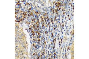Immunohistochemistry of paraffin-embedded human esophageal cancer using V Rabbit mAb (ABIN7271305) at dilution of 1:100 (40x lens). (VAV3 抗体)
