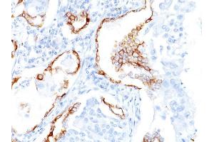 Formalin-fixed, paraffin-embedded human Lung SCC stained with Cytokeratin 7 Mouse Monoclonal Antibody (K72.