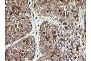 Immunohistochemical staining of paraffin-embedded Adenocarcinoma of Human breast tissue using anti-LSM1 mouse monoclonal antibody. (LSM1 抗体)