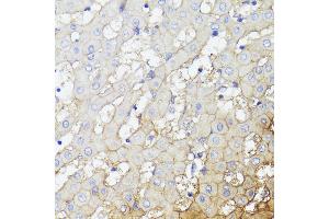 Immunohistochemistry of paraffin-embedded Human liver cancer using CD276/B7-H3 antibody (ABIN7266182) at dilution of 1:100 (40x lens). (CD276 抗体  (AA 100-200))