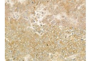 ABIN6263261 and ABIN6277756 at 1/100 staining human melanoma by IHC-P.
