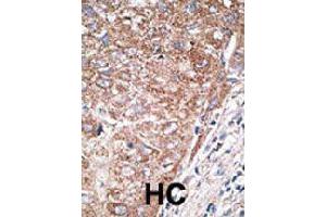 Formalin-fixed and paraffin-embedded human hepatocellular carcinoma tissue reacted with NEUROD1 polyclonal antibody  , which was peroxidase-conjugated to the secondary antibody, followed by DAB staining. (NEUROD1 抗体  (N-Term))
