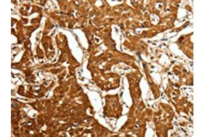 The image on the left is immunohistochemistry of paraffin-embedded Human lung cancer tissue using ABIN7128859(CDH23 Antibody) at dilution 1/80, on the right is treated with fusion protein. (CDH23 抗体)