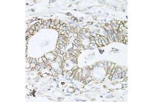 Immunohistochemistry of paraffin-embedded human gastric cancer using ATP1B1 antibody (ABIN5973412) at dilution of 1/100 (40x lens). (ATP1B1 抗体)
